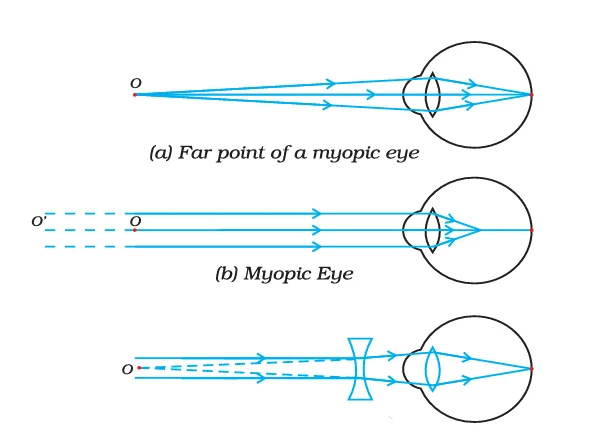 Defects of a Human Eye - Human Eye and the Colourful World Notes